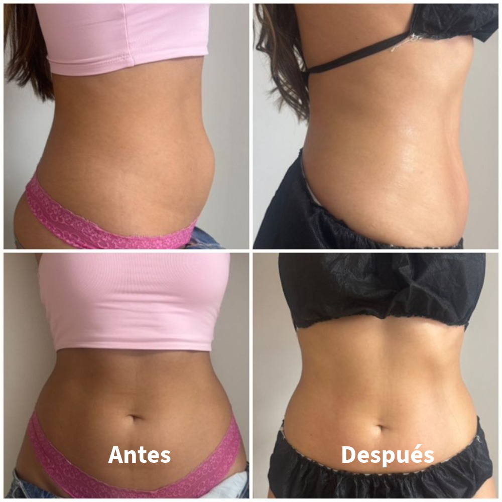 Antes-Despues-1
