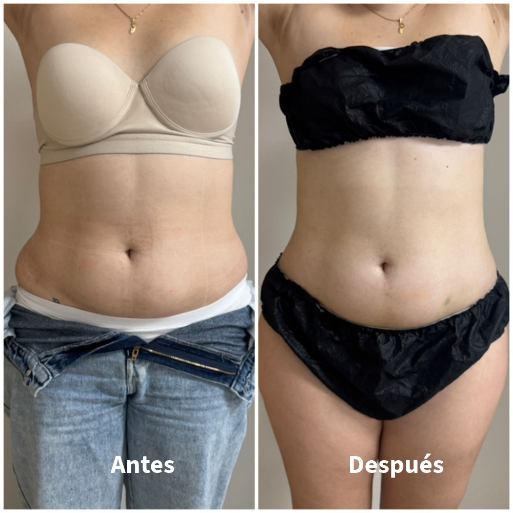Antes-Despues-2