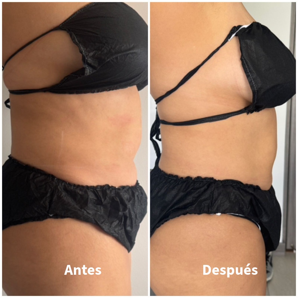 Antes-Despues-3