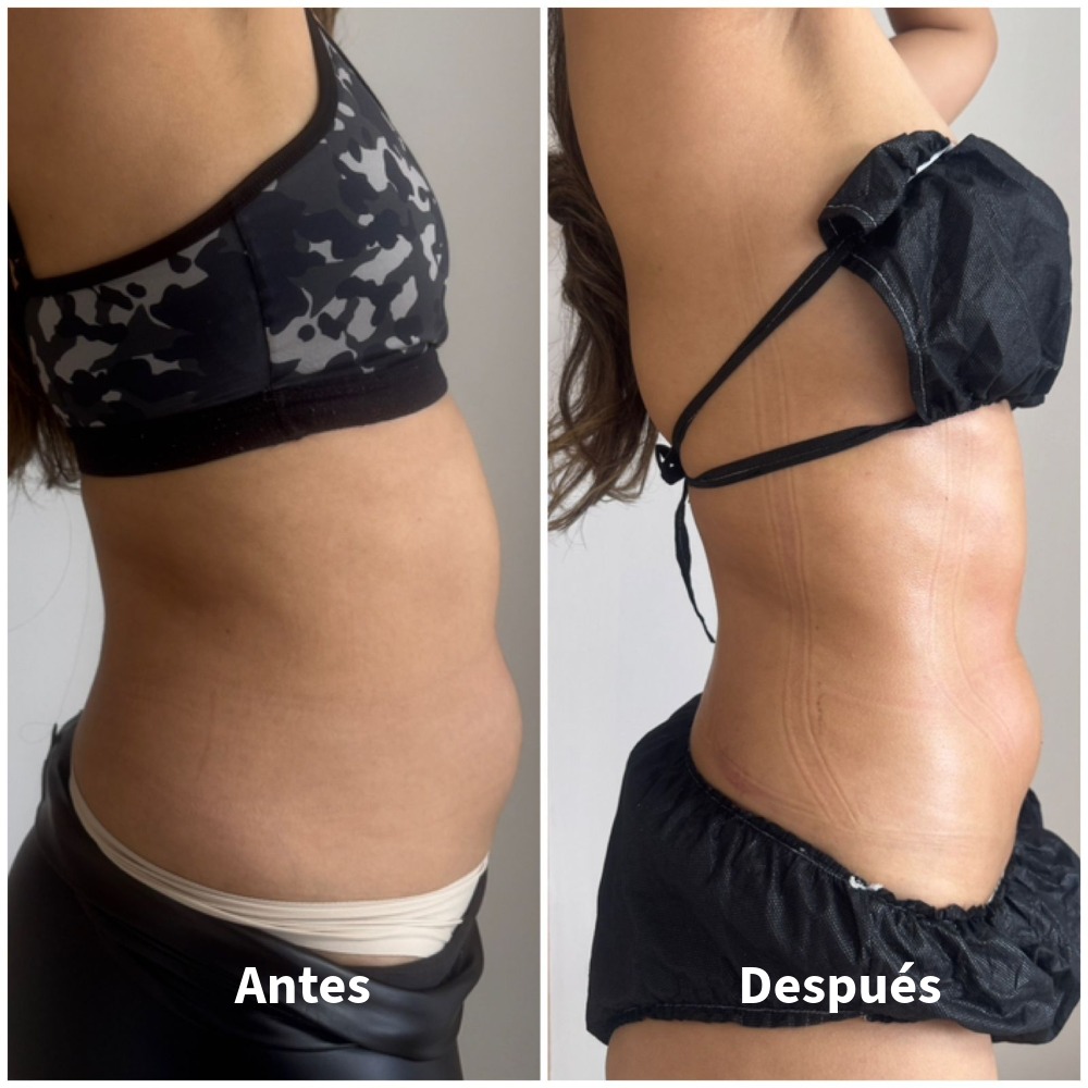 Antes-Despues-4