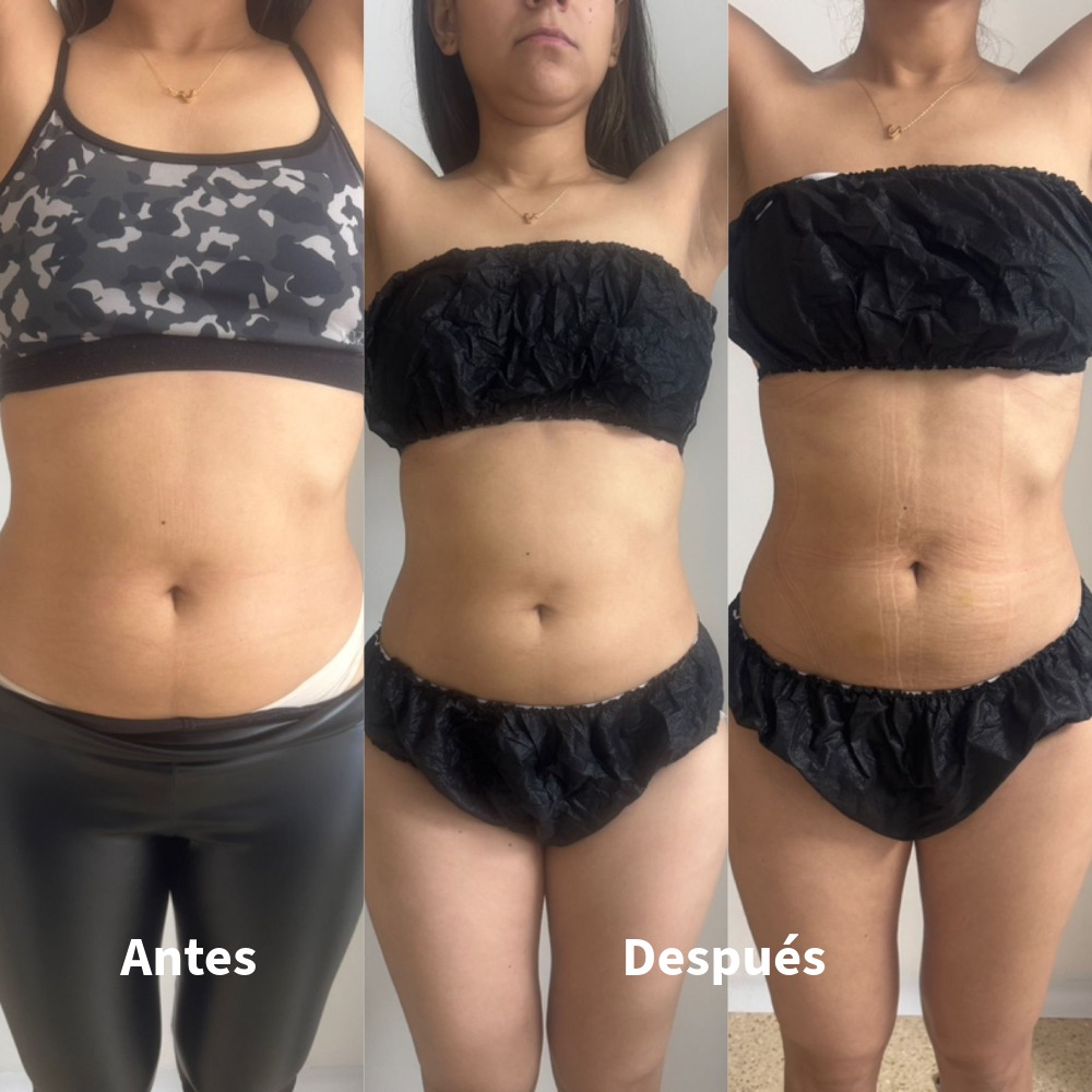 Antes-Despues-5