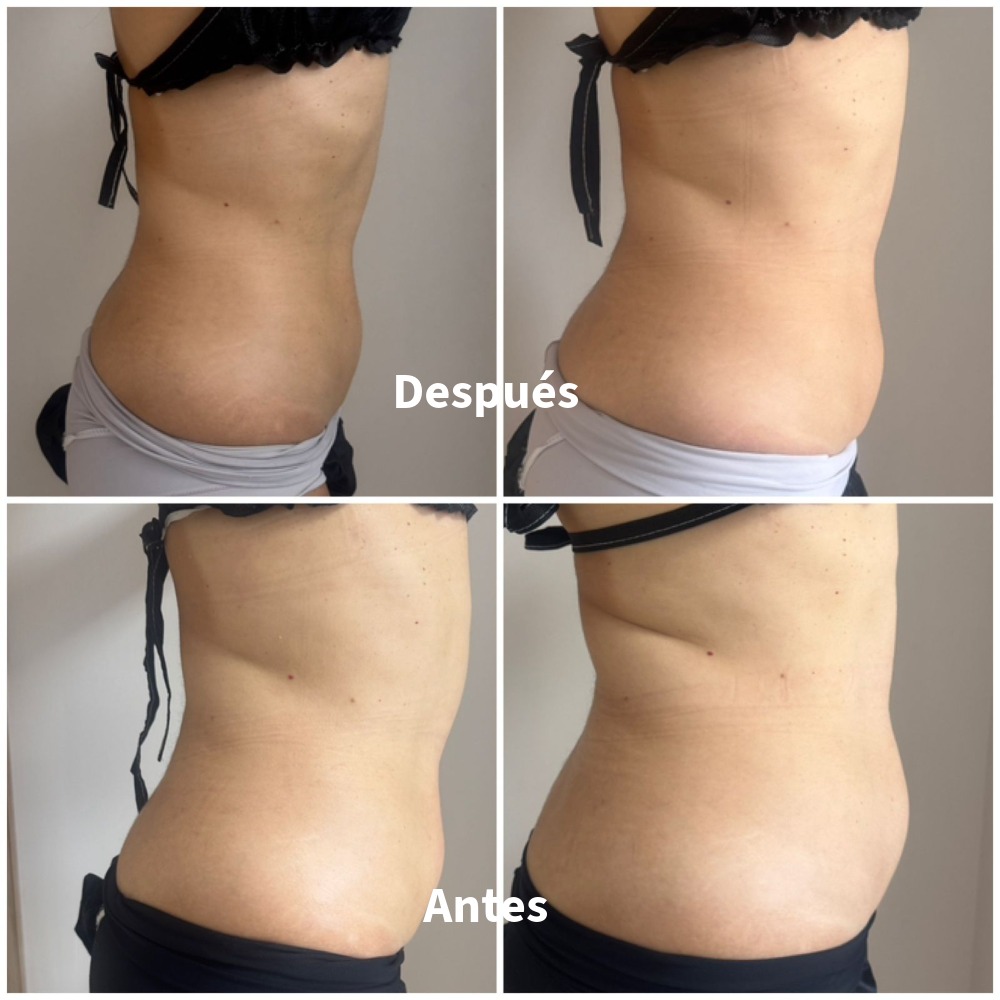 Antes-Despues-6